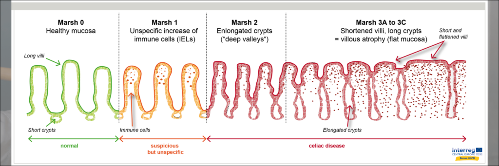В общем, это мутация от здоровой слизистой кишечника до слизистой при целиакии. 